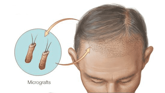 Is a Hair Implant Painful?